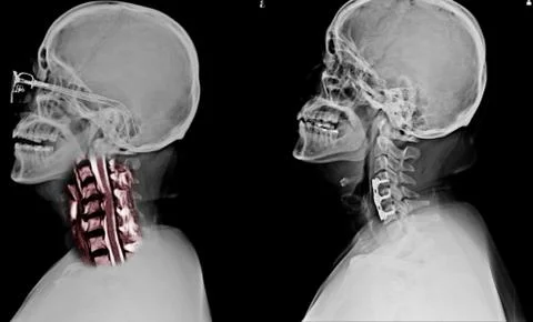C-SPINES showing S/p internal fixation C4-C5 &amp; C6 with plate &amp; screws and The Stock Photos