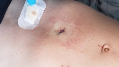 C5377 Cholecystectomy Stock Footage 330076754