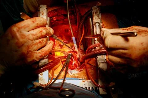 CABG is a type of bypass surgery used for heart operations caused by coronary Stock Photos