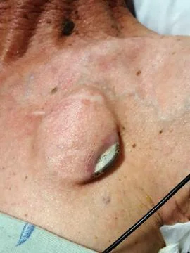 Cachectic patient with pacemaker extrusion from pocket Stock Photos