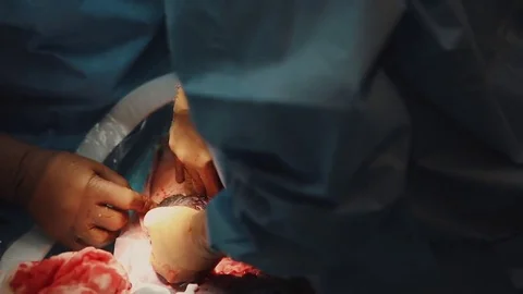 Caesarean section birth surgery operation. close up hands wearing surgical glove Stock Footage 84023834