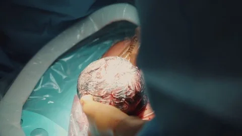 Caesarean section birth surgery operation. close up hands wearing surgical glove Stock Footage 84032276