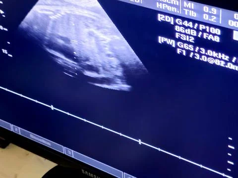 Cairo, Egypt, May 27 2025: Ultrasonography of a pregnant woman showing a he.. Stock Photos