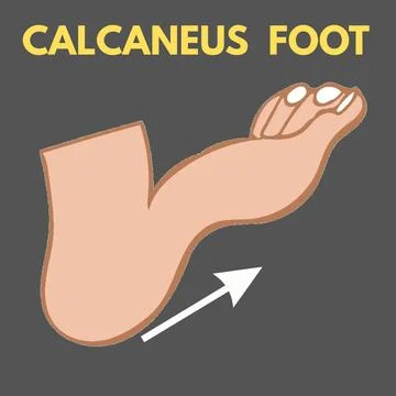 CALCANEUS FOOT - 1 Stock Illustration