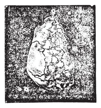 Calculation of sodium urate enchatonne in the bladder mucosa and Stock-Illustration