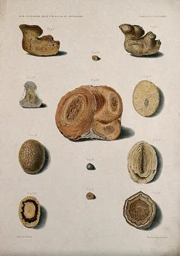 Calculi: twelve examples, including a uric acid calculus from the kidney. C.. Stock Illustration