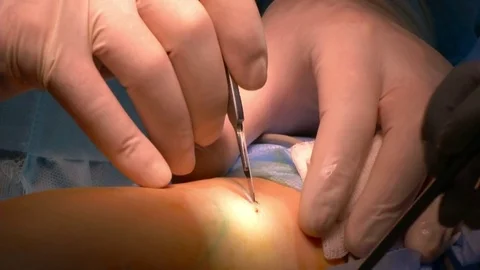 Calf implants. The doctor cauterize bleeding vessels Stock Footage 72615522