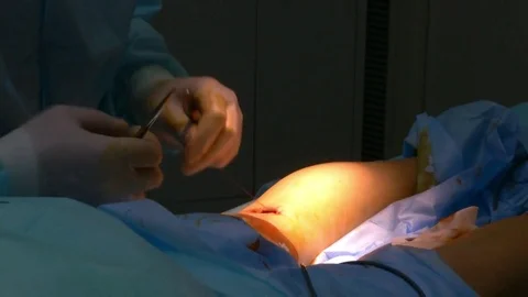 Calf implants. Doctor stitches Stock Footage 73287219