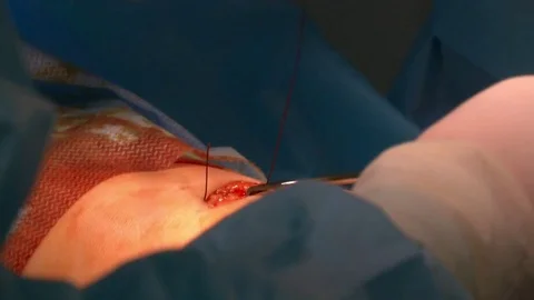 Calf implants. Doctor stitches Video stock 73921244