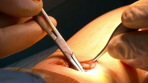 Calf implants. Doctor stitches Video stock 73921547