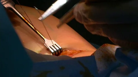 Calf implants. Doctor stitches Video stock 73948799