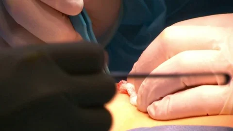Calf implants. Section of a doctor Vidéo 71338272