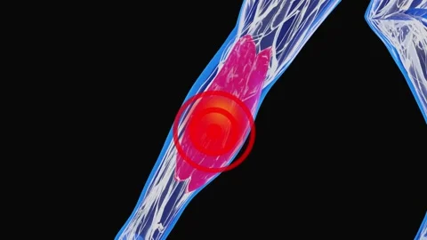 Calf Muscle Strain and Lower Leg Sports Injury Visualization Видео 341836252