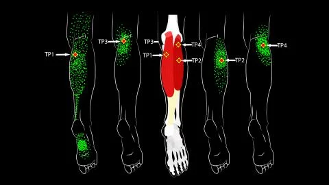 Calf muscle. Trigger points in the leg, reflected pain on the back of the thigh Stock Illustration