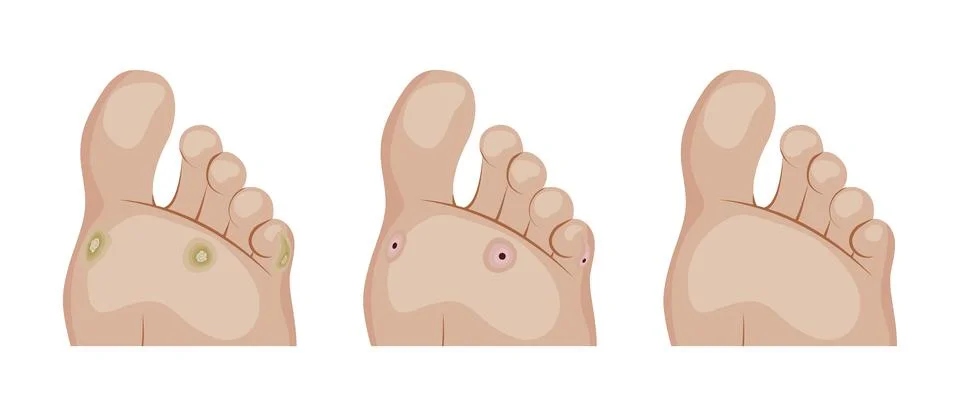 Callus and corn removal process showing different stages of healing Illustrazione stock