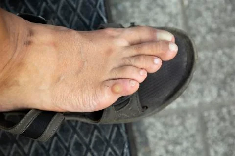Callus on finger Stock Photos
