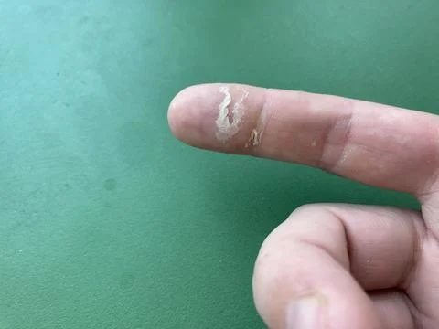 Callus on a man's finger 스톡 사진