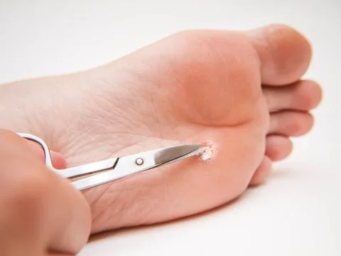 Callus under foot Foto stock