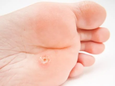 Callus under foot Foto stock
