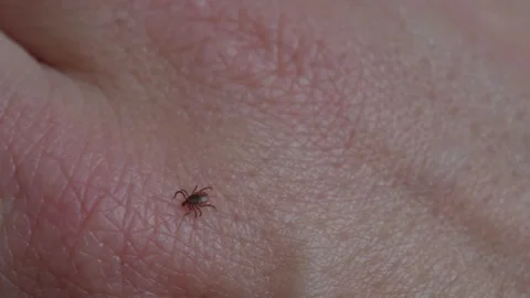 Camera follows tick crawling across human skin symbolizing parasite movement Stock-Footage 319520032