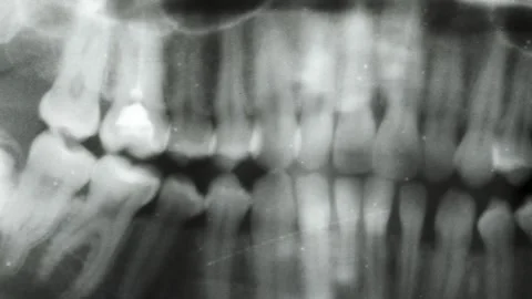 Camera movement along panoramic dental x-ray. Horizontal tracking of upper and Stock Footage 163342439