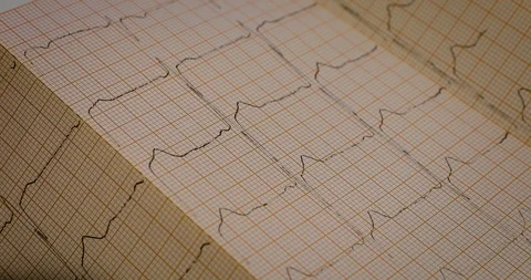 Camera moves from the electrocardiogram to empty tablet package Stock Footage 126282152