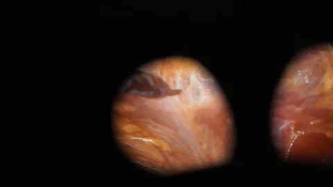 Camera shows patient's internal organs. Robotic operation. Surgeon point of view Stock Footage 89869709