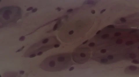 Cancer cells under microscope Stock Footage 41416329