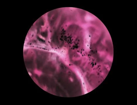 Cancer cells under a microscope. Tissues affected by cancer cells under the m Stock Photos
