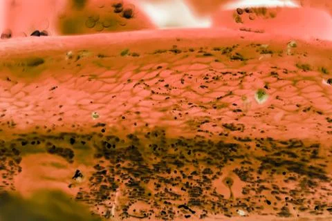 Cancer cells under a microscope. Tissues affected by cancer cells under the m Stock Photos