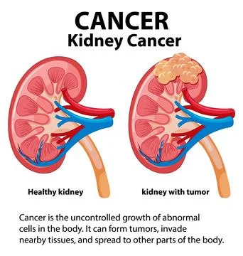 Cancer Development Process in Human Kidney: A Comparative Analysis Stock Illustration