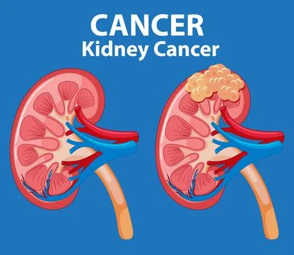Cancer Development Process in Human Kidney Stock Illustration