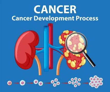 Cancer Development Process on Human Kidney: An Infographic Stock Illustration