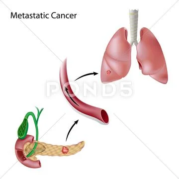 Cancer spreads through blood circulation Stock Illustration