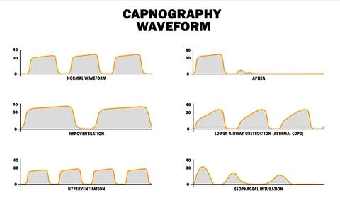 Capnography waveform - different conditions Stock Illustration
