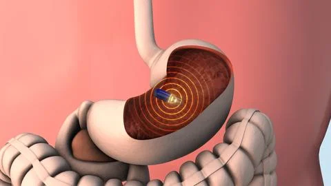 Capsule endoscopy and wireless communication Stock Illustration