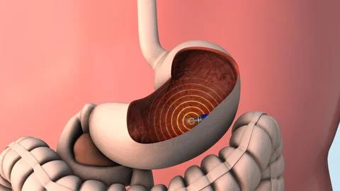 Capsule endoscopy and wireless communication Stock Illustration