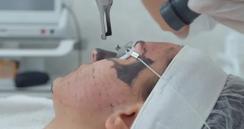 Carbon face peeling procedure. Laser pulses clean skin of the face. Hardware Stock Footage 120181309