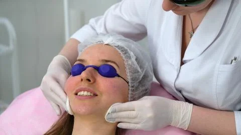 Carbon face peeling procedure. Foto stock