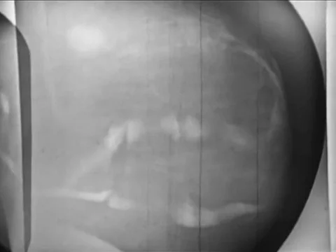 Carcinomas are detected on mammogram x-rays in 1965. Stock Footage