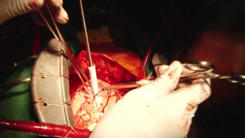Cardiac arrest surgery Stock Footage 130377302