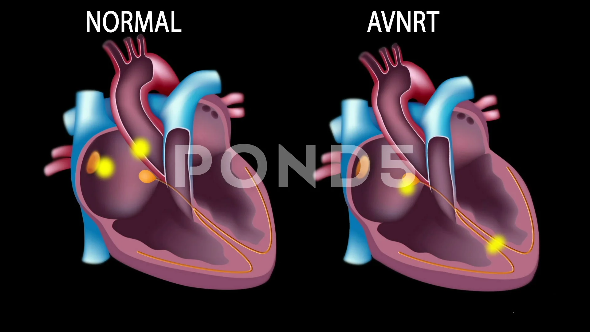 Cardiac arrhythmias: AVNRT, animation | Stock Video | Pond5