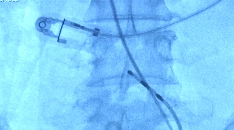Cardiac catheterization, Coronary angiography Stock Footage 43970879