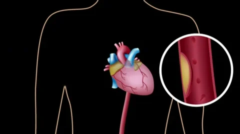 Cardiac catheterization | Stock Video | Pond5