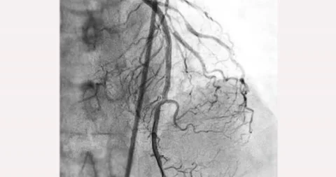 Cardiac catheterization. Stock Footage 239802707