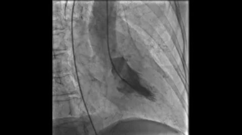 Cardiac Catheterization Scans 3731 Stock Footage 32128793
