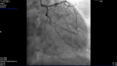Cardiac Coronary angiogram Stock-Footage 83428872