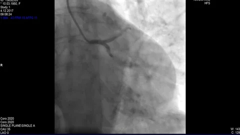 Cardiac Coronary angiogram Stock Footage 83428873