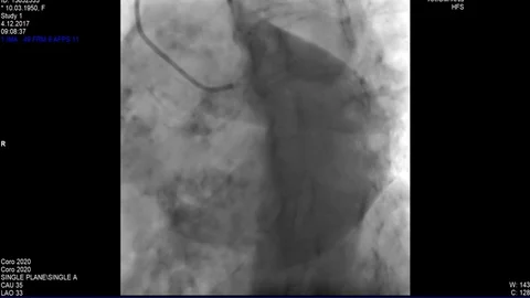 Cardiac Coronary angiogram Stock Footage 83428877