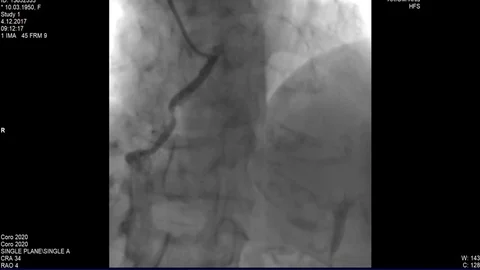 Cardiac Coronary angiogram Stock Footage 83428883